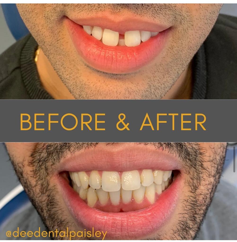 before and after Invisalign treatment in Glasgow