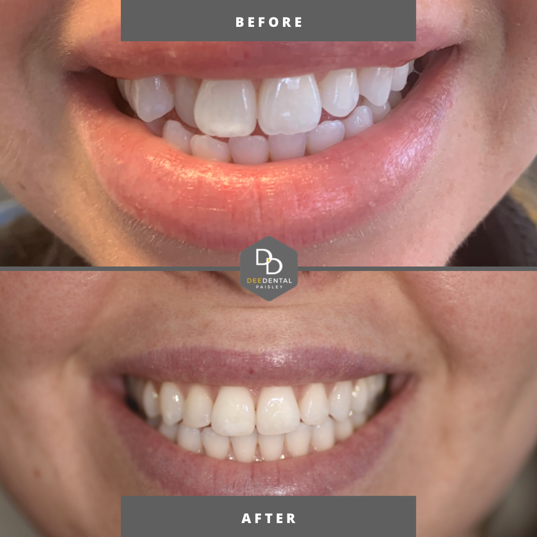 before and after Invisalign teeth straightening 