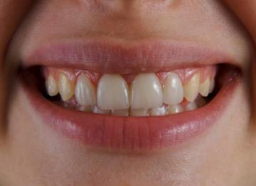 Composite Bonding vs Veneers: Which Is Right for You? 