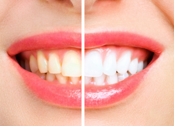Professional Teeth Whitening vs Whitening Kits: Which Works Better? 