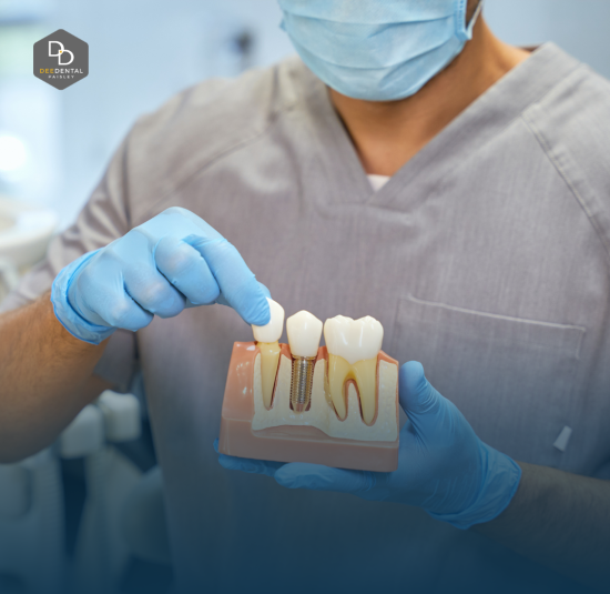 Dental Implants