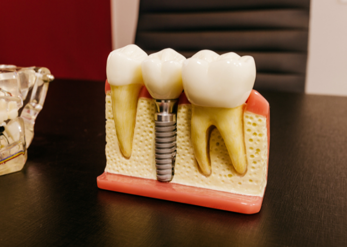 dental implant model