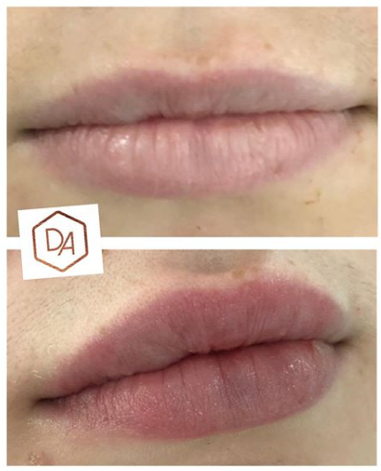 lip filler treatment Glasgow