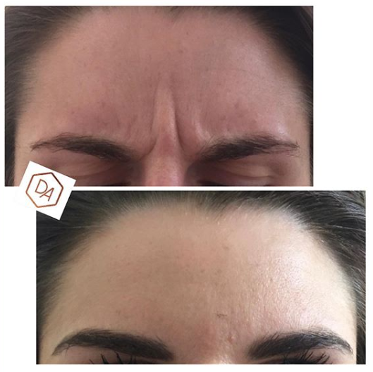 anti-wrinkle treatment results