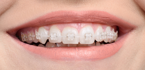 Clear adult braces for quick straight teeth