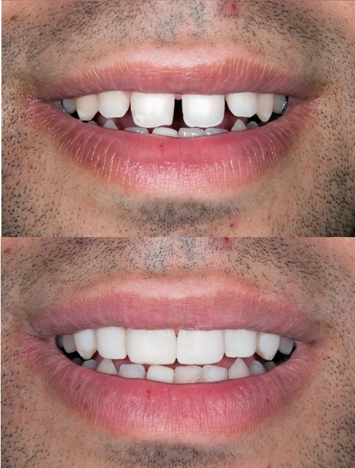 close up of man with gaps in his teeth
