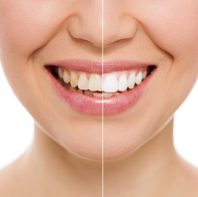 Beautiful white smile after teeth whitening treatment