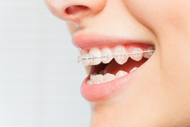 Clear adult Braces for quick straight teeth