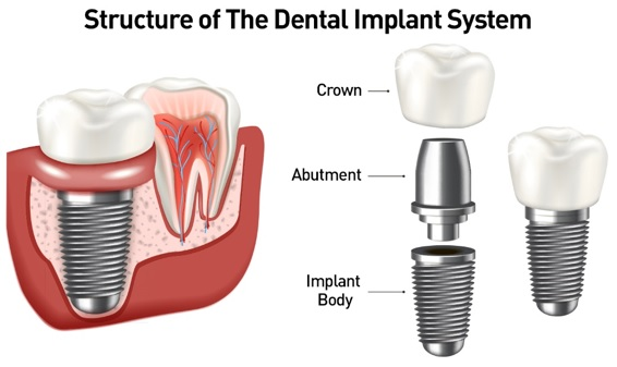 structure of a dental implant explained 