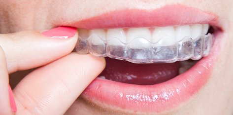 removable braces as part of the Invisalign treatment