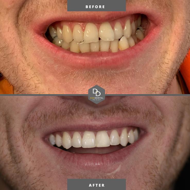 Invisalign treatment Paisley 