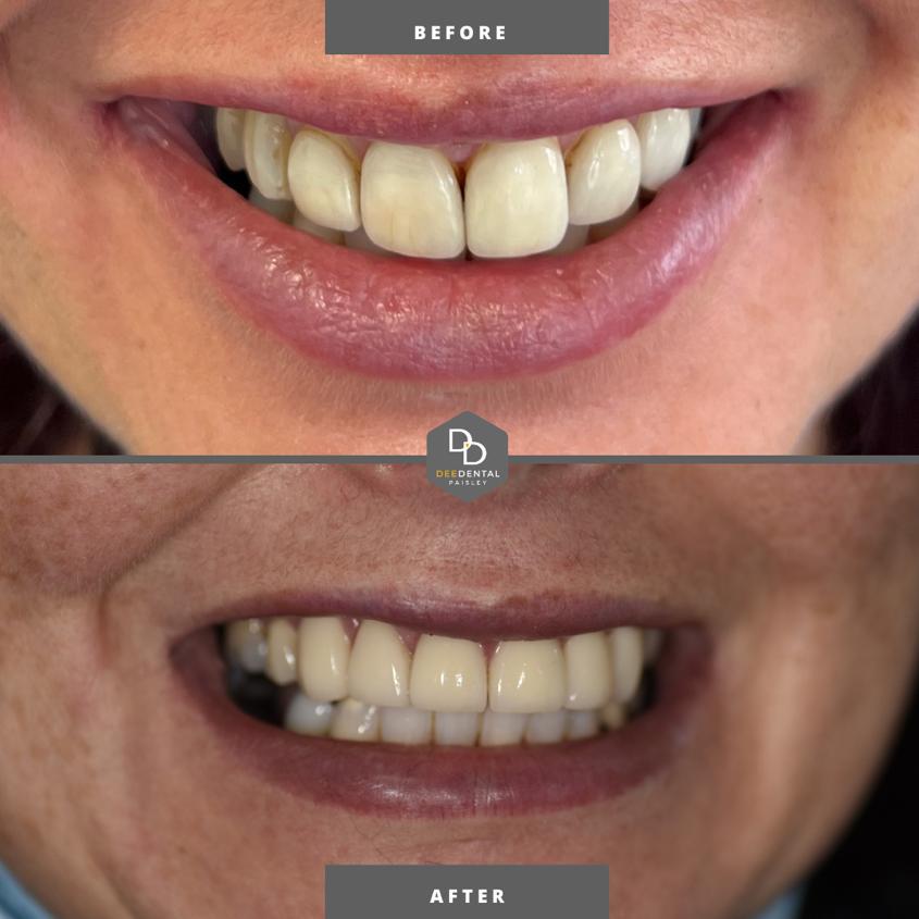 teeth whitening before and after