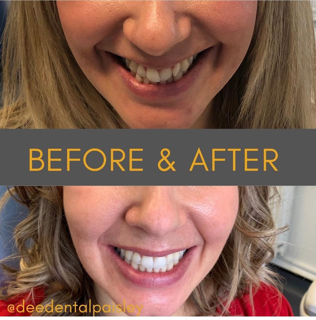 Before and after Invisalign treatment 