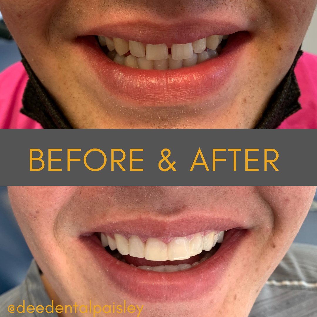 composite bonding before and after