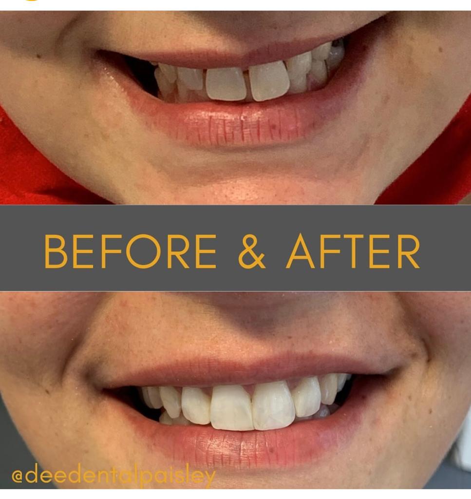 before and after composite bonding treatment
