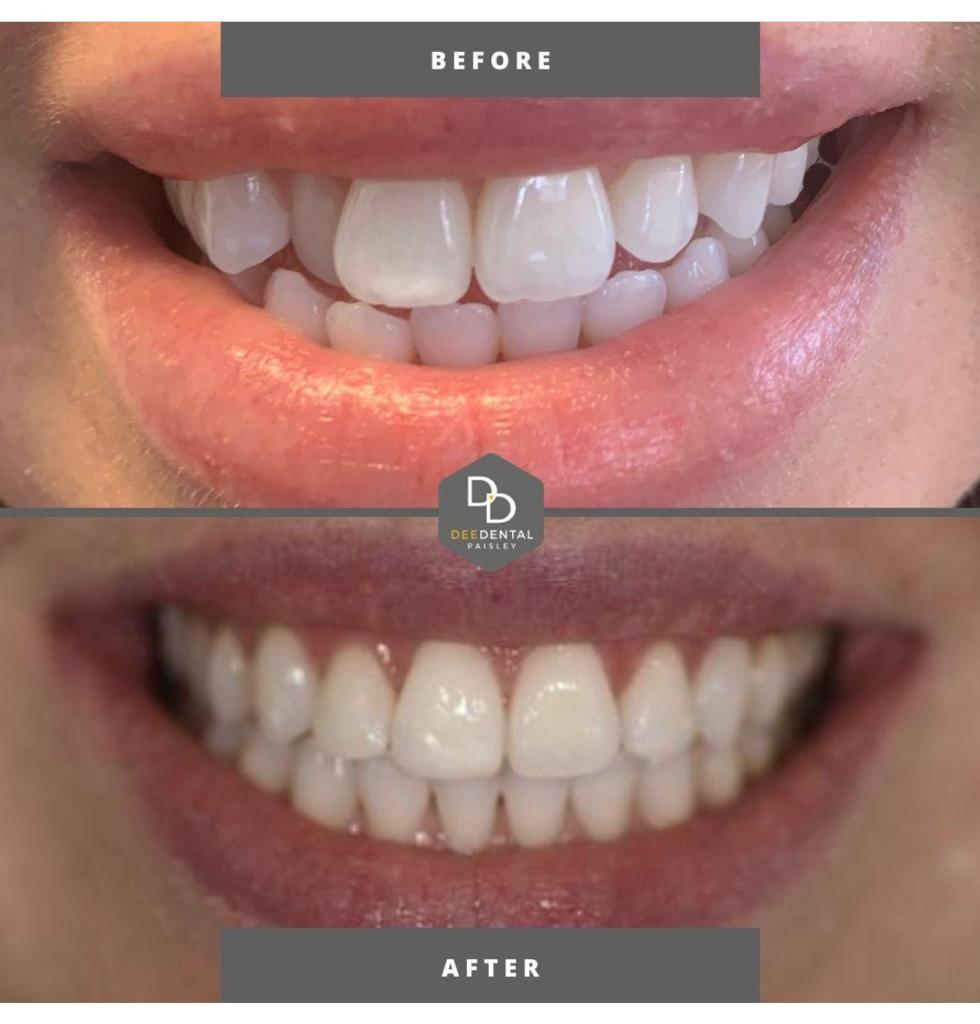 before and after a smile makeover