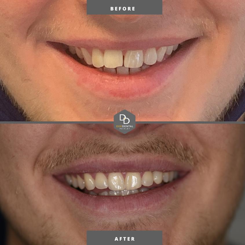 before and after with cosmetic dentistry