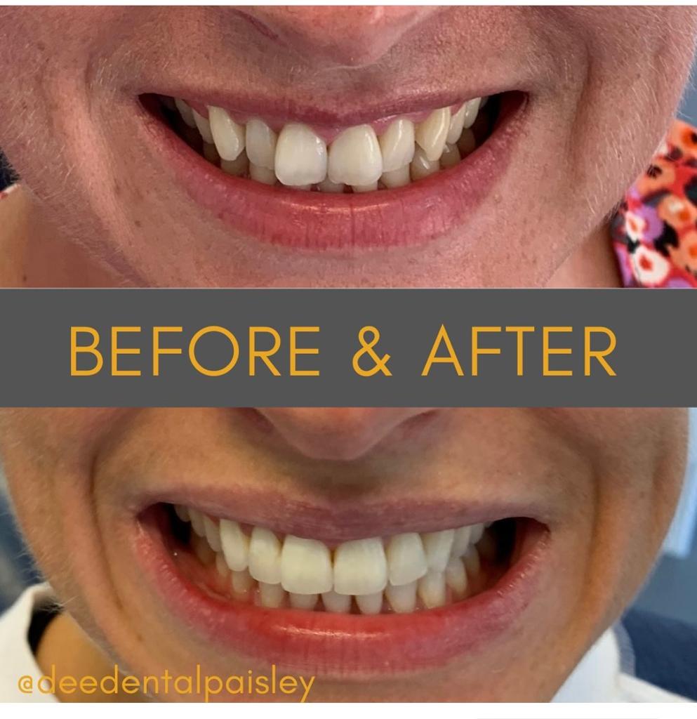 Invisalign before and after example