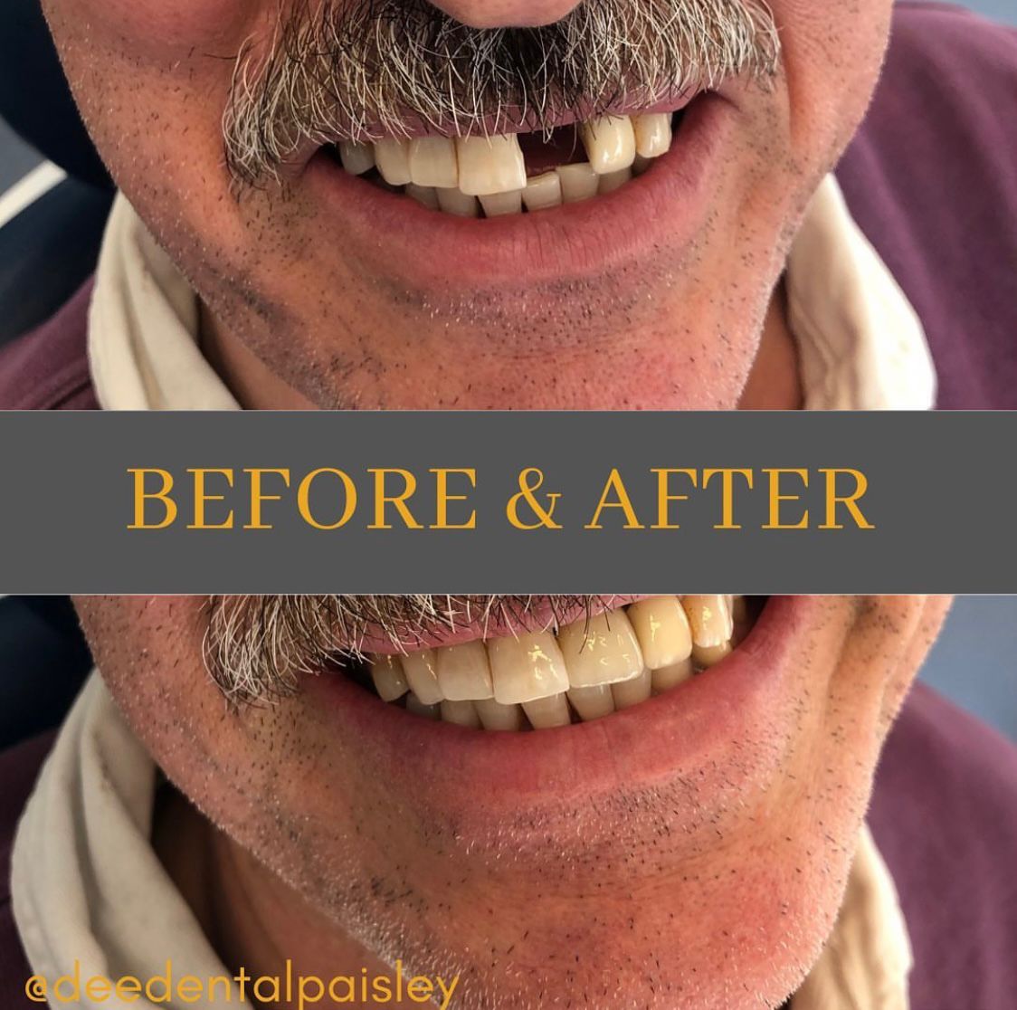 dental implants before and after