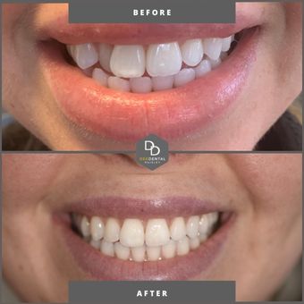 Invisalign treatment before and after