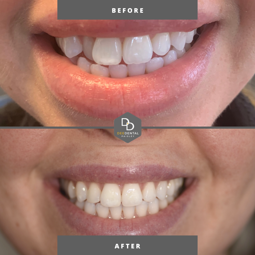 complete smile makeover Glasgow