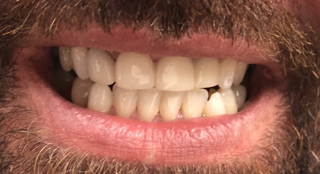 close up of man with straight teeth